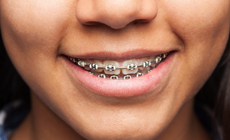 Metallic braces